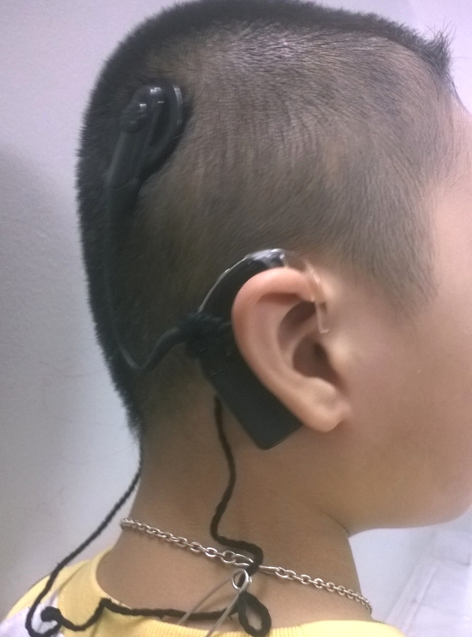 Phụ kiện cần thiết khi sử dụng Máy trợ thính hoặc Điện cực ốc tai